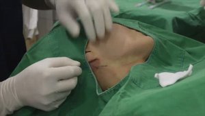 Neck Lifting with MINT FINE 15
