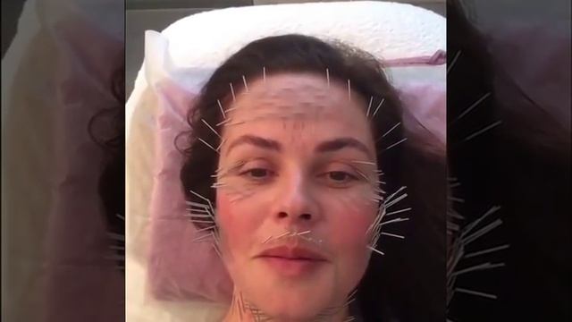 Иглотерапия лица фото до и после
