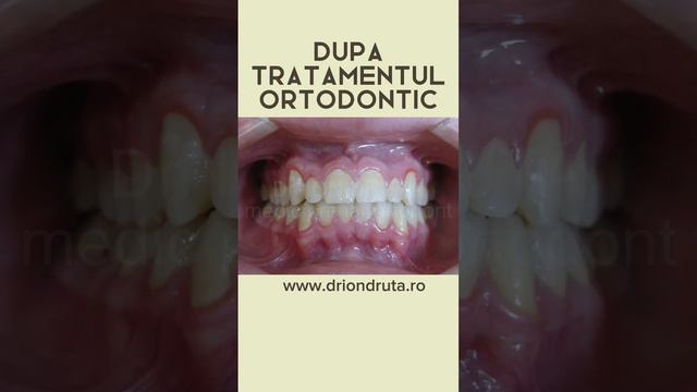 Caz rezolvat Dr. Ion Druta #medicortodont #tratamentortodontic #aparatdentar #dintialiniaticorect