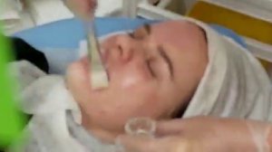 АирисКом студенты учатся: применение ТСА и ретиноевого пилинга в одной процедуре.