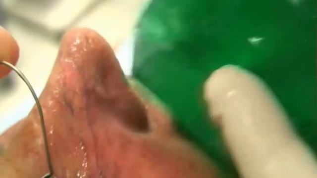 Laser Excel de Cutera смотреть онлайн