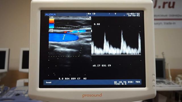 Aloka Alpha 5 обзор ультразвукового сканера смотреть онлайн