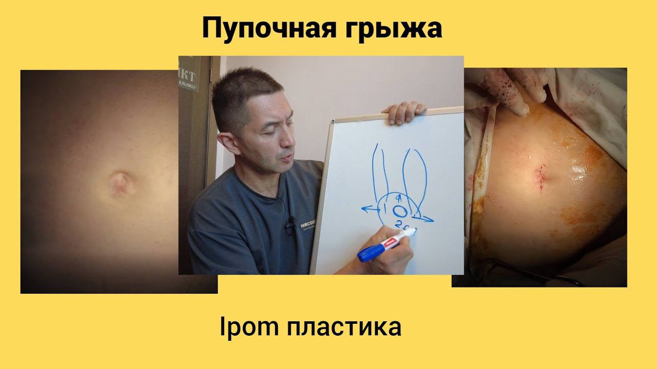 Пупочная грыжа . IPOM пластика.