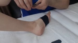 Исправление вальгусной деформации большого пальца Hallux Valgus