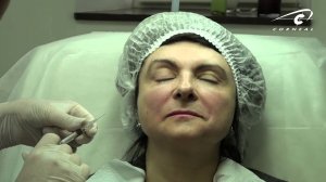 Коррекция ассиметричных губ Princess филлером