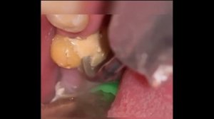 удаления зубного камня смотреть на ютуб _tartar removal watch on youtube