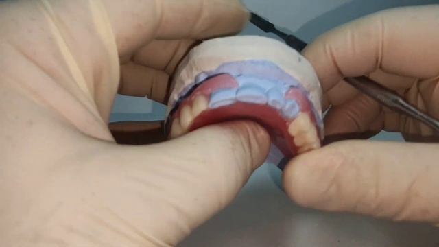 Чем отличаются зубные протезы из нейлона термопласта и акрила! смотреть онлайн