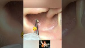 Огромный прыщ!!! Сочный прыщ давим!!! Жесть.
