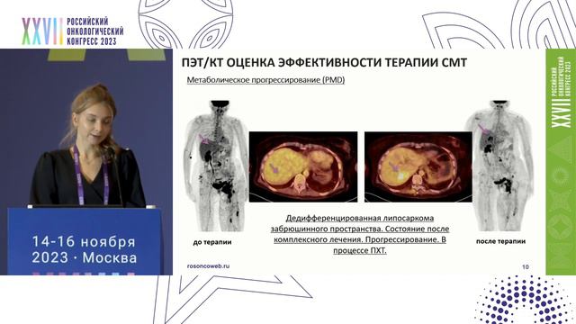 ПЭТ/КТ оценка терапии сарком мягких тканей
