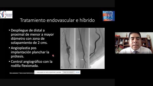 ATENEO Aneurisma de Arteria Poplitea смотреть онлайн