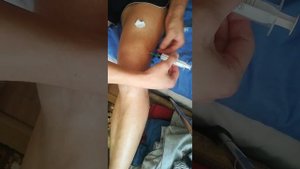 как откачать жидкость из колена в домашних условиях. Не повторять.