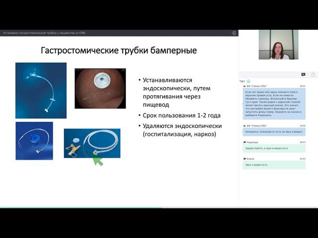 Установка гастростомической трубки у пациентов со СМА