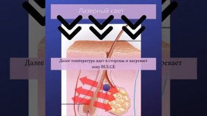 Что такое лазерная эпиляция_.mp4