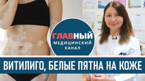 Витилиго: фото, причины, лечение и препараты. Как лечить белые пятна на коже