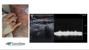 Стилл синдром ультразвуковая характеристика - Still syndrome ultrasound characteristics
