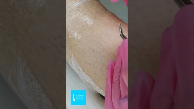 Электроэпиляция, релакс видео