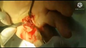 dupuytren's contracture; контрактура дюпюитрена; 18 +