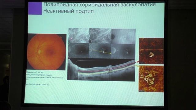 ОКТ-ангиография в клинической практике (РООФ 2015) смотреть онлайн