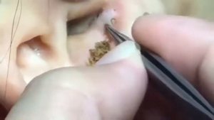 # 2 Выдавливание большой чёрной точки. Popping big a pimple relax