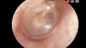 Эндоскопия уха: хронический средний отит, ретракционный карман