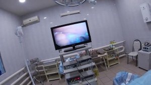 Сигмостома. Лапароскопическая сигмостомия. Рак сигмовидной кишки.Laparoscopic sigmoidostomy. Cancer