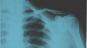 как сломать ключицу.flv