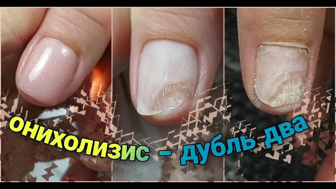 Онихолизис Дубль 2