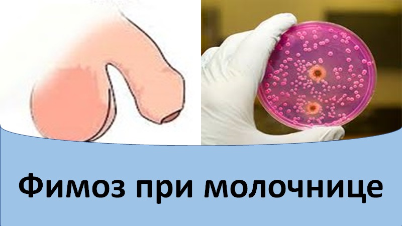 Фимоз при молочнице.