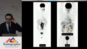 Преимущества и недостатки метаболической ПЭТ-КТ в онкологии. Николай Новиков