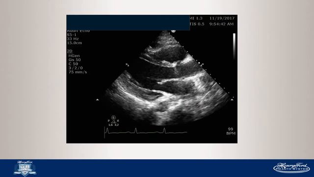 Severe cardiomyopathy смотреть онлайн