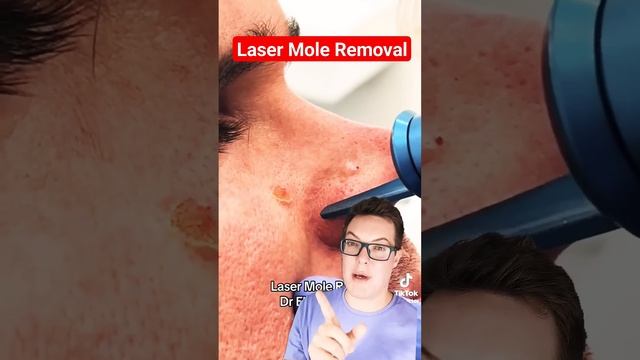 Dramatic LASER MOLE REMOVAL - Mole Removal Before And After shorts