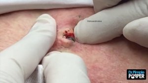 Two HUGE Dilated Pores of Winer!!
