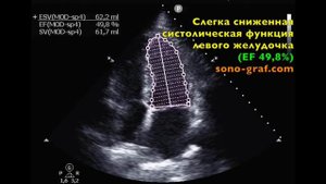 203 - Эхокардиография - Слегка сниженная систолическая функция левого желудочка по методу Симпсона