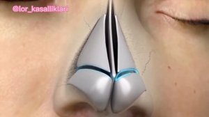 Ринопластика , 3D анимация закрытой ринопластика.