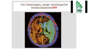 канал Галины Ковалевой ACLON Н  Шабанова  Сосуды головного мозга  09 01 2018