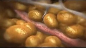 Вакуумно-роликовый массаж на аппарате Shape V8
