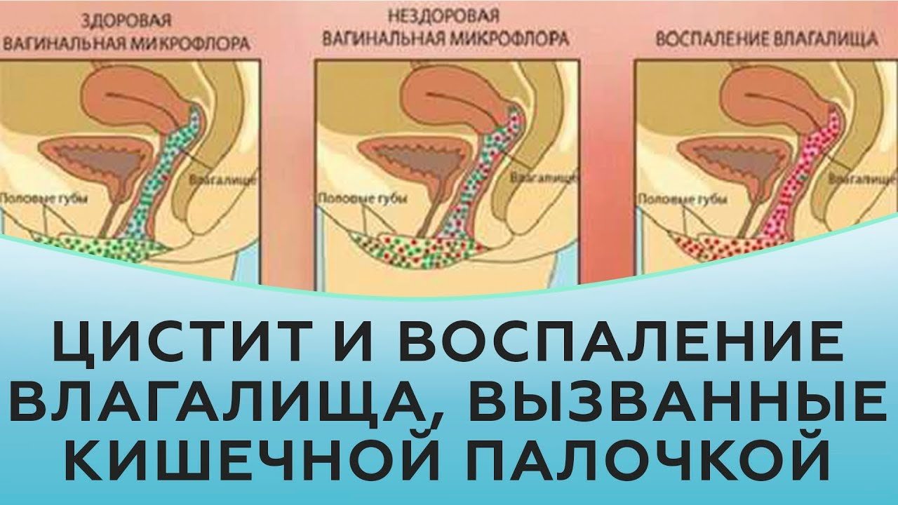 Цистит и воспаление влагалища, вызванные кишечной палочкой.