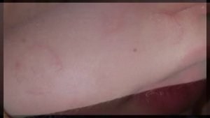 Пятна с красным ободком на коже