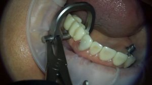 Демонтаж коронок пневмокопом