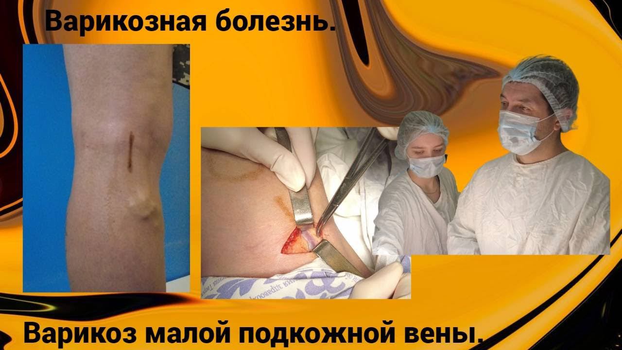 Варикозная болезнь. Варикоз малой подкожной вены.