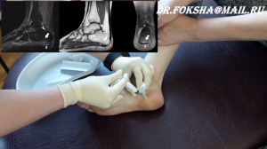 Блокада ПЯТОЧНАЯ ШПОРА Лечение Plantar Fasciitis