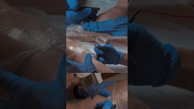 Шокирующие результаты! Узнайте, как электроэпиляция может преобразить вашу кожу!