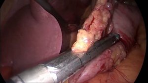 Продольная резекция желудка SLEEVE gastrectomy