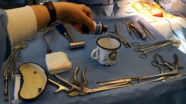 Гемоблок при хирургическом лечении спондилолизного спондилолистеза L5 позвонка
