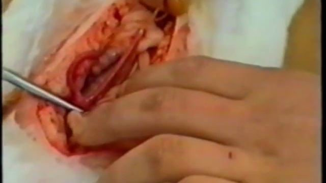 Лікування корів при випадінні піхви та матки смотреть онлайн