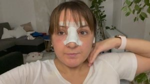 Ринопластика: ДО и ПОСЛЕ