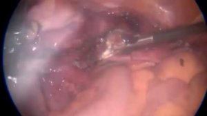 TLH . Steps. Лапароскопическая гистерэктомия . Этапы .