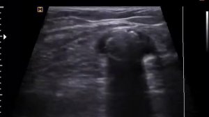 Киста Беккера с крупным кальцинатом