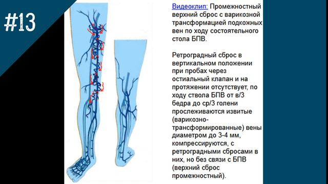 УЗИ Вен.  Промежностный верхний сброс с варикозной трансформацией подкожных вен.
