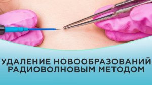 Удаление новообразований радиоволновым аппаратом типа Сургитрон